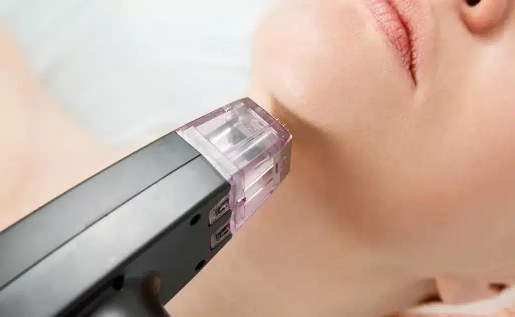 Top Reasons to Choose RF Microneedling Toronto for Skin Tightening